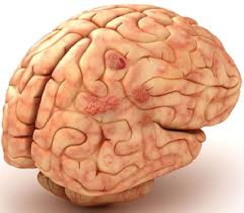 دانلود فایل  پاورپوینت درباره عفونتهای مغزی