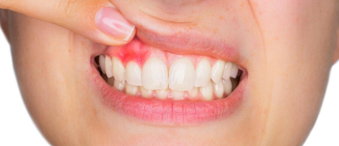 پاورپوینت آسیب های دندانی ناشی از ضربه