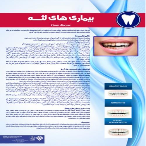  پوستر بیماری های لثه - مجموعه پوسترهای دندانپزشکی