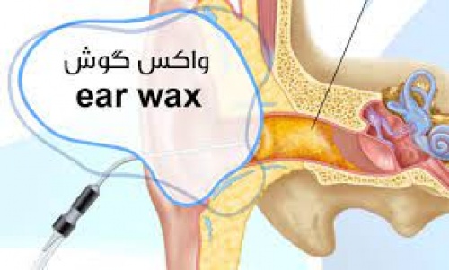  واکس گوش(Ear Wax)