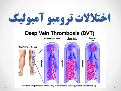  اختلالات ترومبوآمبولیک 