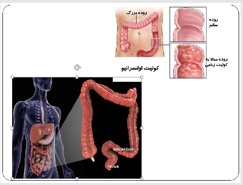   پاورپوينت با عنوان سرطان کولون و رکتوم