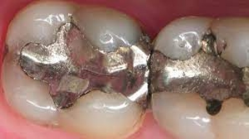  ترمیم آمالگام(Amalgam restoration  )