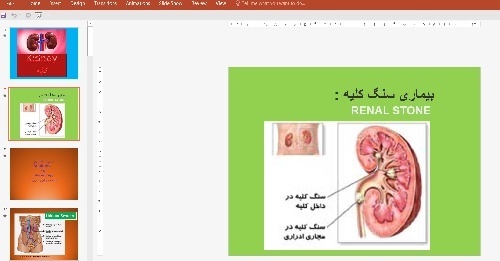  پاورپوینت بیماری سنگ کلیه