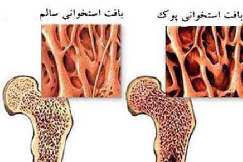  پاورپوینت کامل و جامع با عنوان پوکی استخوان در 48 اسلاید