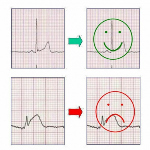  ECG  و تفسیر آن