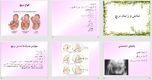   پاورپوينت با عنوان نمایش و زایمان بریچ