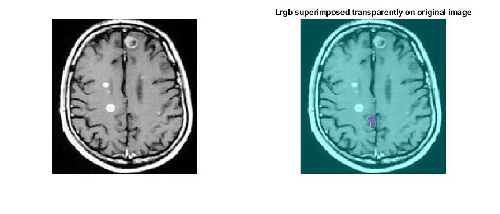  کد متلب تشخیص تومور مغزی در تصویر MRI