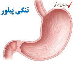 جلسه سیزدهم تنگی هیپرتروفیک پیلور (ppt) 24 اسلاید