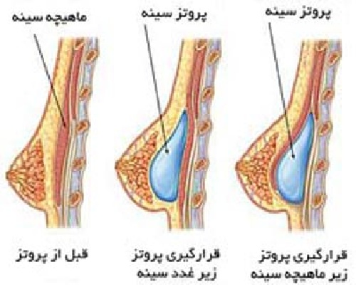  مقاله ای کامل در مورد عمل جراحی زیبایی پروتز سینه (بزرگ کردن سینه)