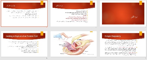  پاورپوينت با عنوان درد لگن