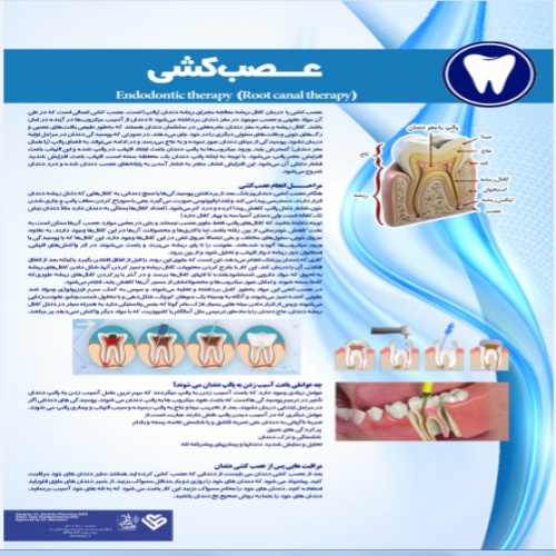  پوستر عصب کشی دندان- مجموعه پوسترهای دندانپزشکی