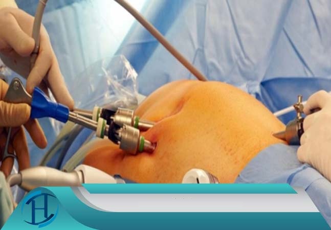 پاورپوینت فرآیند پرستاری برای بیمار تحت عمل جراحی معده