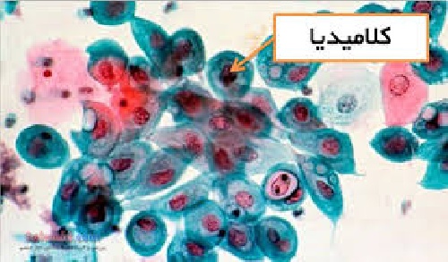  دانلود تحقیق  در مورد ميزان شيوع  عفونت ادراري تناسلي كلاميديا تراكوماتيس 