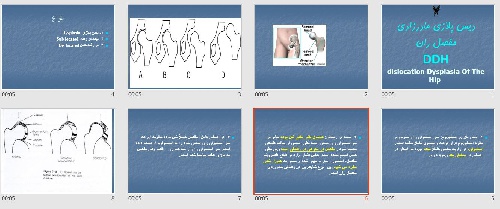  پاورپوينت با عنوان دیس پلازی مادرزادی مفصل ران DDH dislocation Dysplasia Of The Hip 