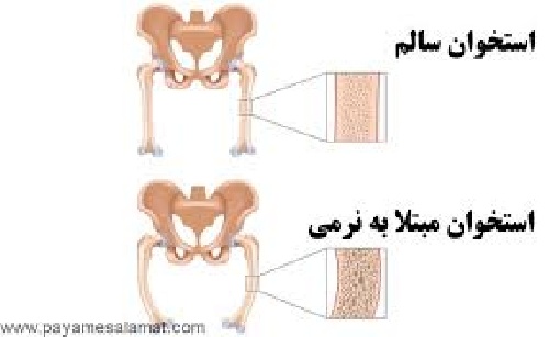  تحقیق نرمی استخوان