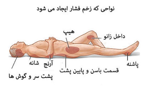  جزوه آموزشی زخم بستر؛  شناخت،پیشگیری و درمان